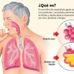 Se puede bañar un paciente con neumonía
