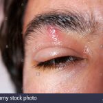 Piquete de mosco en el ojo