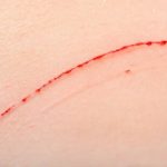 Despues de arañazo de gato enrojecimiento alrededor