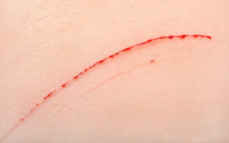 Despues de arañazo de gato enrojecimiento alrededor