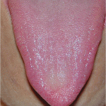 Manchas moradas en la lengua
