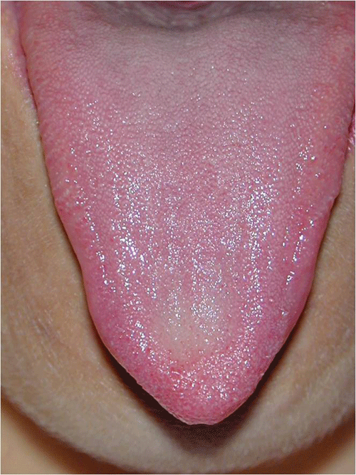 Manchas moradas en la lengua