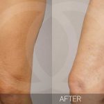 Mesoterapia muslos antes y despues