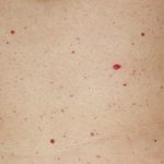 Puntos rojos en la piel como sangre
