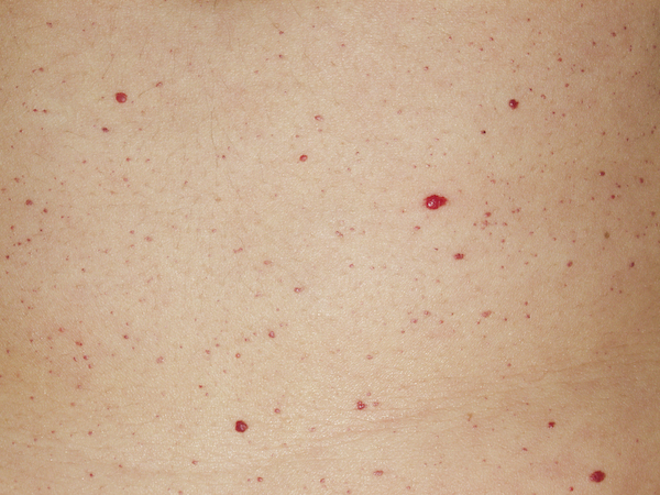 Puntos rojos en la piel como sangre
