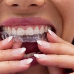 Ortodoncia invisible en Madrid avances y tendencias en la salud dental